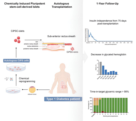 Reversal of type 1 diabetes with stem cell transplantation.